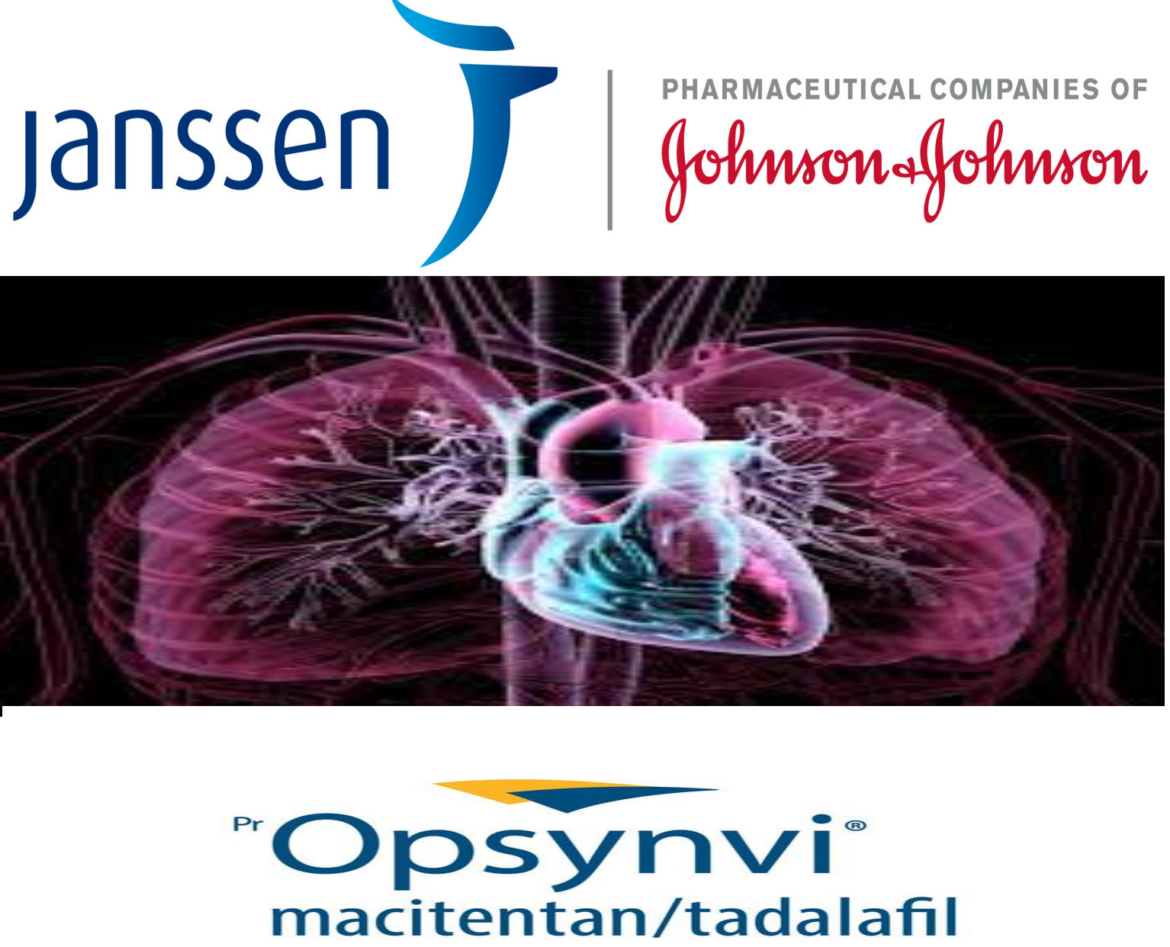 Janssen’s OPSYNVI (Macitentan And Tadalafil) Becomes The First And Only ...