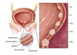 Non-Muscle Invasive Bladder Cancer (NMIBC)